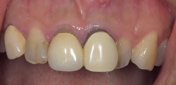 前歯の審美領域の治療