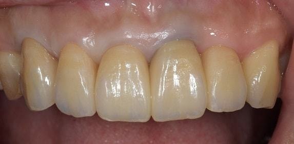 前歯の審美領域の治療