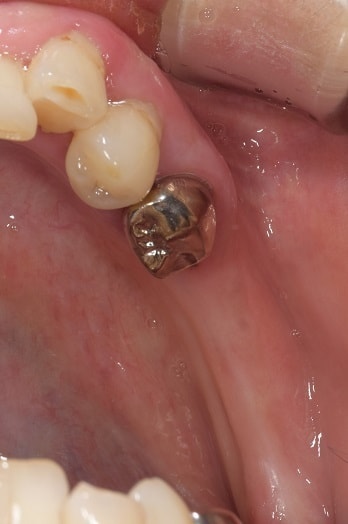 インプラント治療例