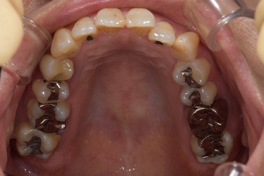 インプラント治療例