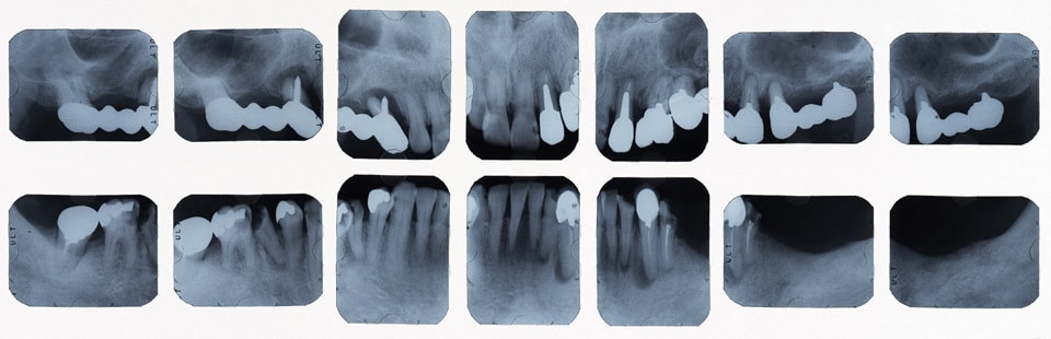 総合的な歯の治療例