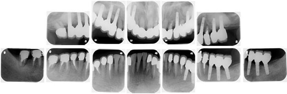 治療後レントゲン